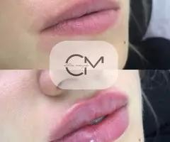 ❌SIN AGUJAS ❌ SIN DOLOR