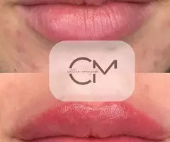 ❌SIN AGUJAS ❌ SIN DOLOR - 2