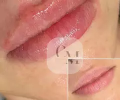 ❌SIN AGUJAS ❌ SIN DOLOR - 4