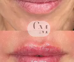 ❌SIN AGUJAS ❌ SIN DOLOR - 5